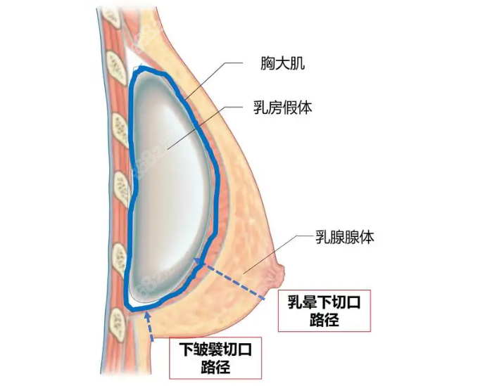 梦萦假体vs星熠vs璀璨区别对比,梦萦完胜!形态手感价格碾压