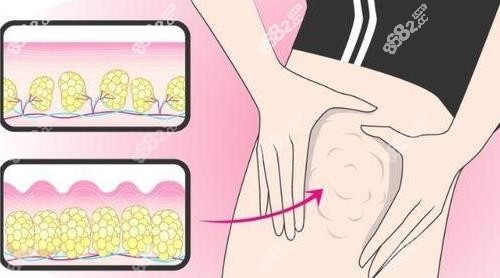 邓晟华抽脂怎么样