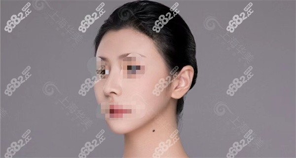 上海华美隆鼻实例3