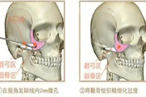 西安颧骨内推术后显著的医院推荐