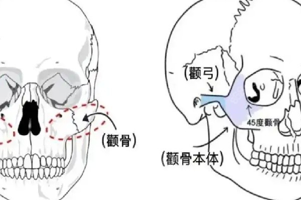 西安颧骨内推医院的优质选择