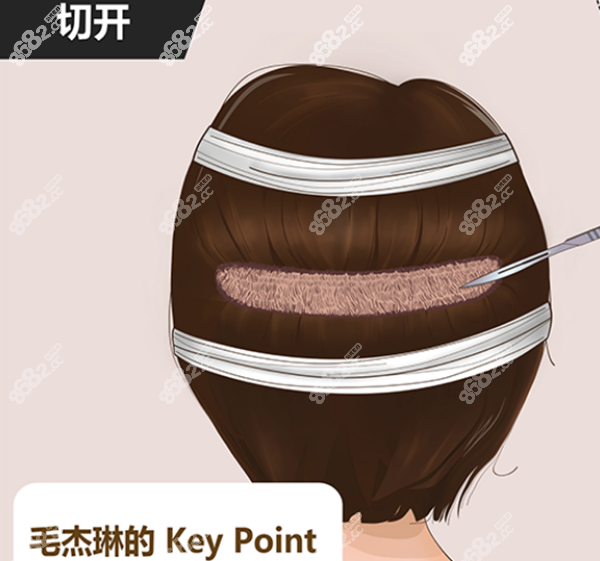 毛杰琳非切开毛发移植 8682.cc网