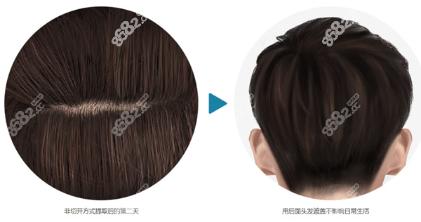 毛杰琳非切开毛发移植图片