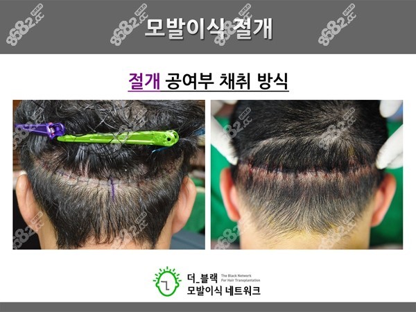 韩国布莱克做切开植发图片 8682网