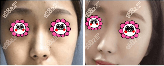 上海美莱面部提升怎么样？埋线提升案例参考