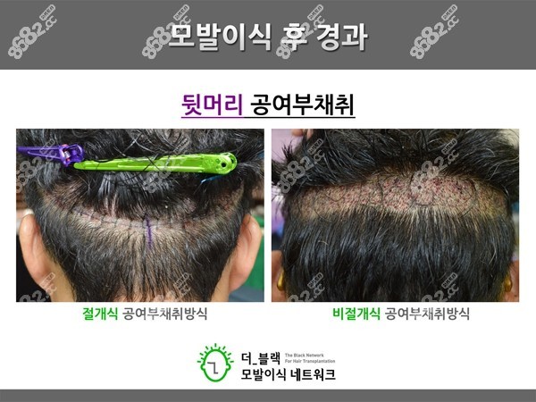 韩国布莱克切开植发和非切开植发