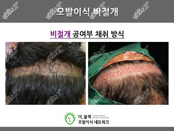 韩国布莱克做非切开植发图片 8682.cc