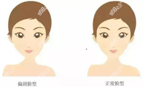 什么是偏颌？