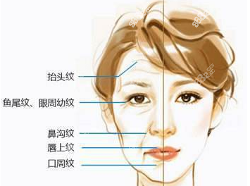 双平面提升术全脸价格多少贵吗？