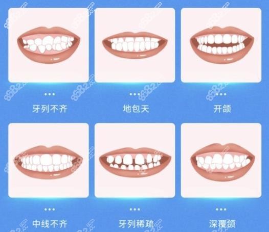 舟山儿童早期干预矫正地包天反颌多少钱