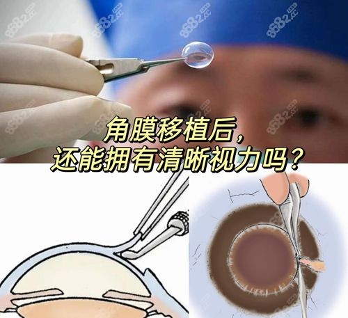 國內(nèi)眼角膜移植好的醫(yī)院排名：匯總有資質(zhì)的水平高醫(yī)院10家