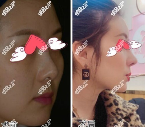 段焘医生做的肋骨鼻修复真人实例