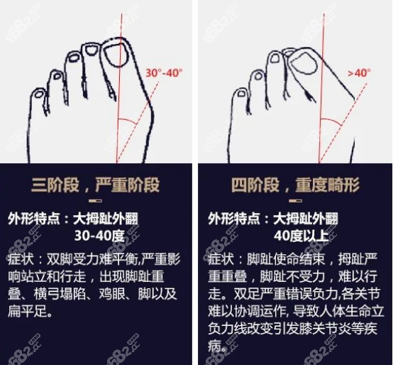 <!--<i data=20240705-sp></i>-->做大脚骨矫正真的很神奇 <!--<i data=20240705-sp></i>-->做大脚骨矫正真的很神奇