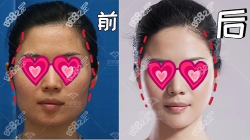 朱石江颧骨内推效果图