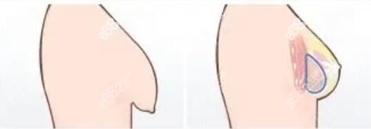 假体隆胸术后会不会加重乳房下垂