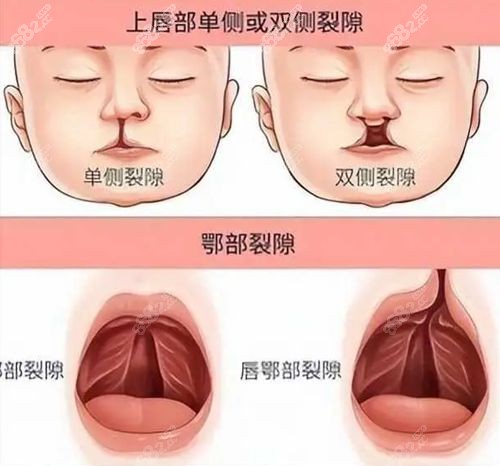 2025唇腭裂免費救助新政:先天性唇腭裂政策+定點醫(yī)院查詢