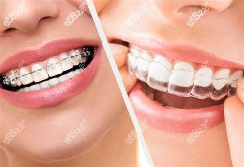 昆明美奥口腔牙齿矫正示意图