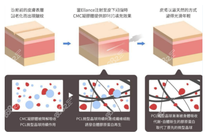伊妍仕少女针注射后作用过程图解