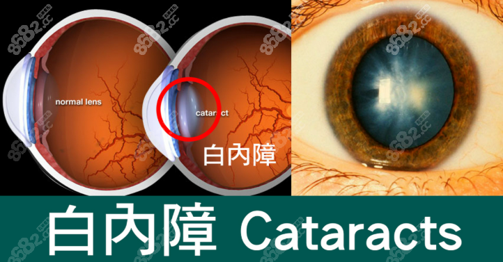 邢臺眼科醫(yī)院白內(nèi)障晶體價目表:國產(chǎn)進口差1.5萬,選對省一半