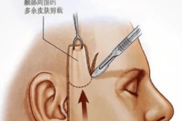 賀煥煥做拉皮提升怎么樣？揭秘賀煥煥拉皮提升顧客口碑特