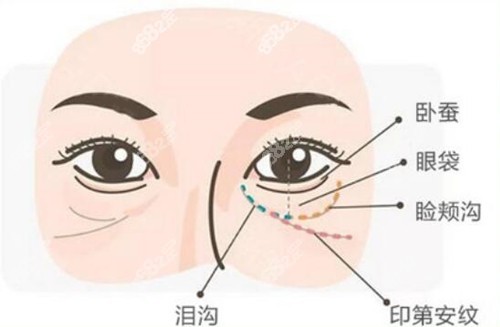 印第安紋可以用玻尿酸填充嗎？哪里去印第安紋效果好？