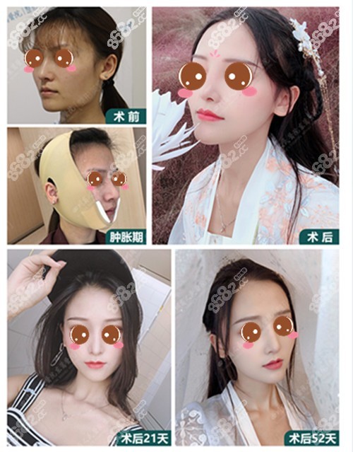 李運(yùn)峰做過的下頜角手術(shù)效果圖