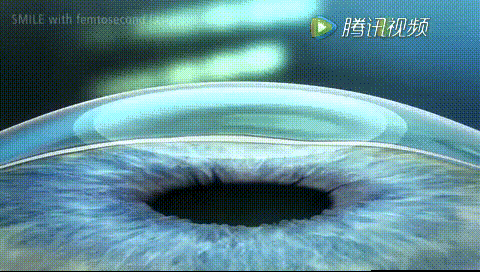 半飛秒手術(shù)