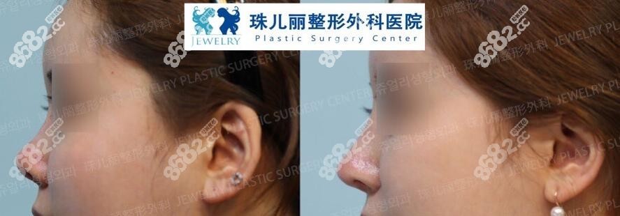 鼻修复病例对比图