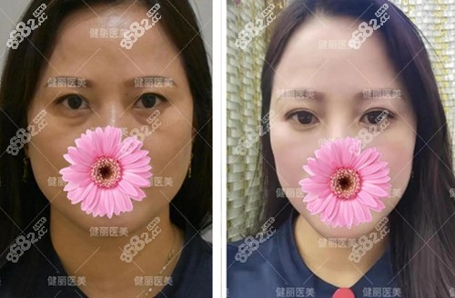 成都健丽张登洋去眼袋案例