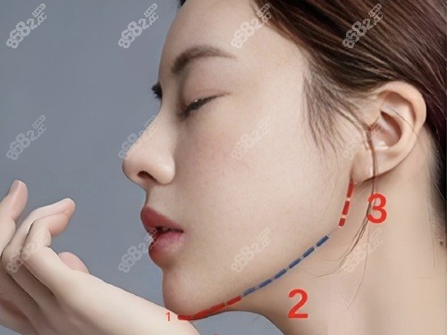重慶松山肖林做正頜預(yù)約指南：在線預(yù)約肖林做正頜超方便