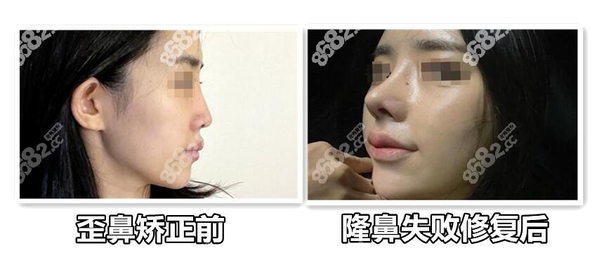 鼻修复整容图片