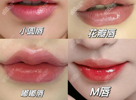玻尿酸丰唇