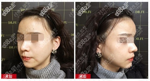 付国友院长超长下颌角+颧骨颧弓实例