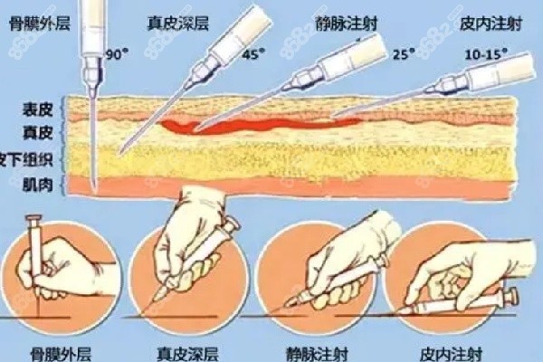 海魅云鏡0.3毫升