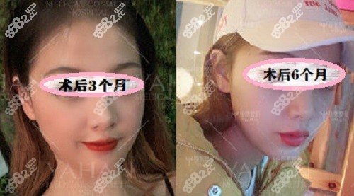 赵贵庆院长长曲线下颌角截骨实例