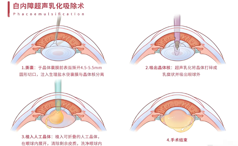 白內(nèi)障手術(shù)