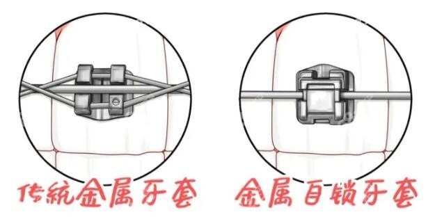 武隆金属托槽矫正器价格