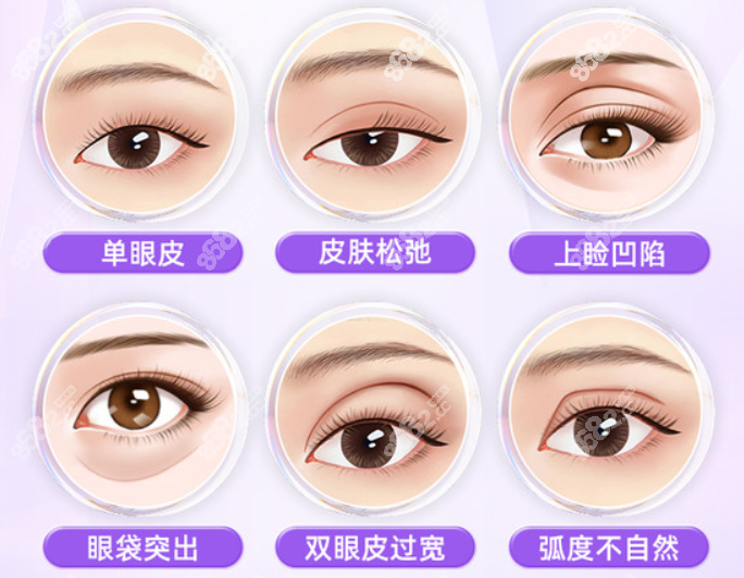 丽水华美整形割双眼皮怎么样