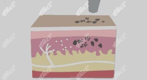 <!--<i data=20240705-sp></i>-->蜂巢皮秒激光去除纹身