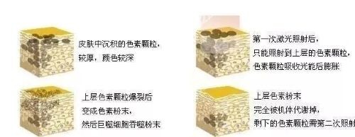 <!--<i data=20240705-sp></i>-->蜂巢皮秒激光去除纹身