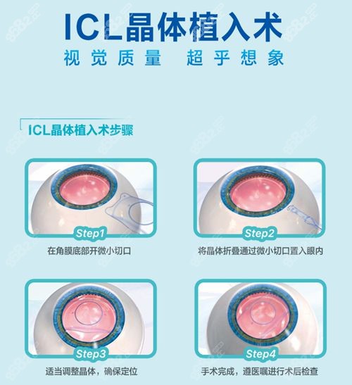 河南 icl 晶体植入好的医生排名前一是刘保松