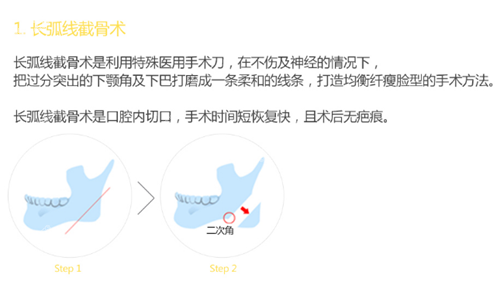 韩国珠儿丽长曲线下颌角方法