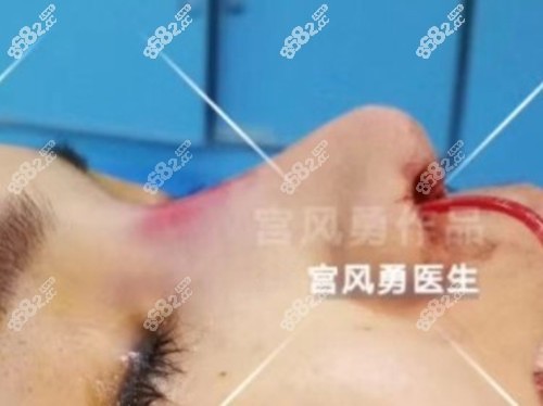 北京聯(lián)合麗格宮風(fēng)勇醫(yī)生做鼻修復(fù)手術(shù)范例