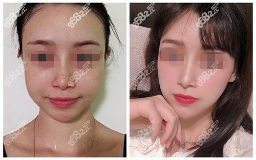 下颌角手术案例