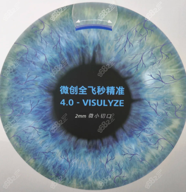 广州余克明全飞秒激光近视手术费用
