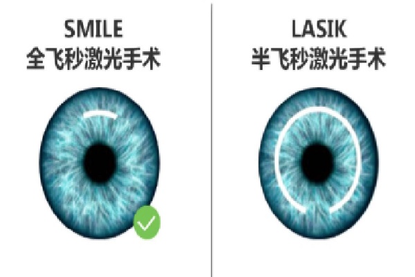 广州市第医院近视怎么样？看激光近视手术有费用医生哪些