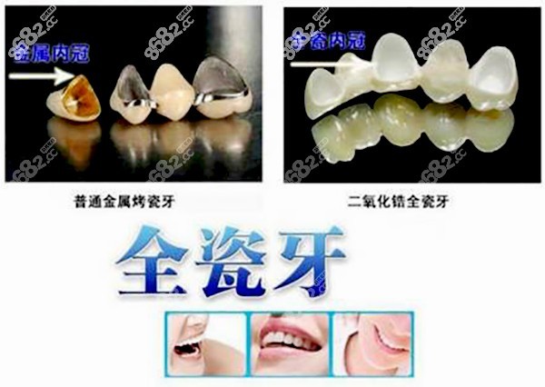 圣贝牙科牙冠价格