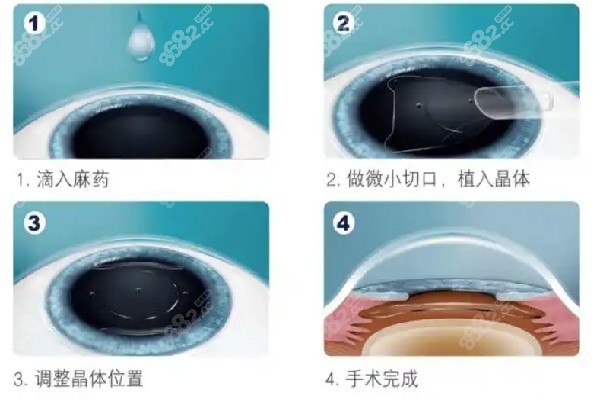 广州市第医院准分子激光近视手术价格区间