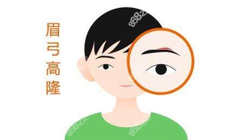 晏國富做的豐眉弓實例