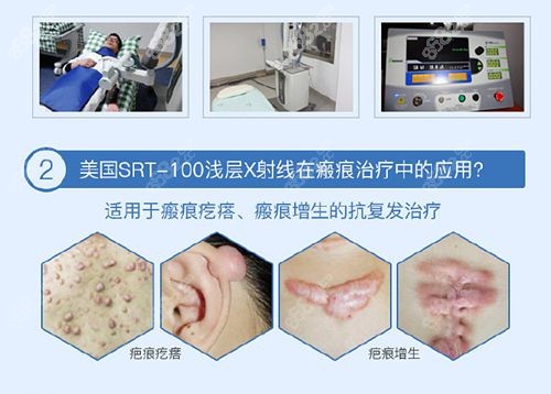 武汉这5家有srt100浅放,武汉正璞|美莱治疤痕疙瘩单次3000元+